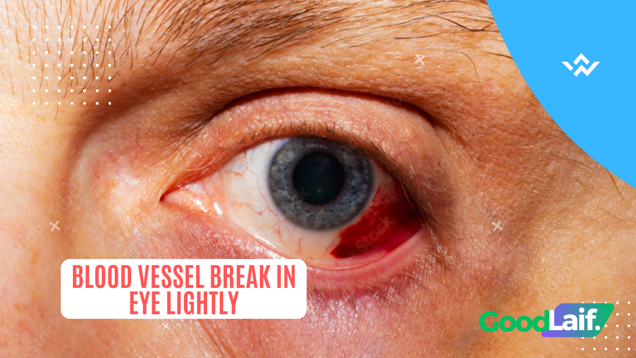Don't Take Blood Vessel Break In Eye Lightly