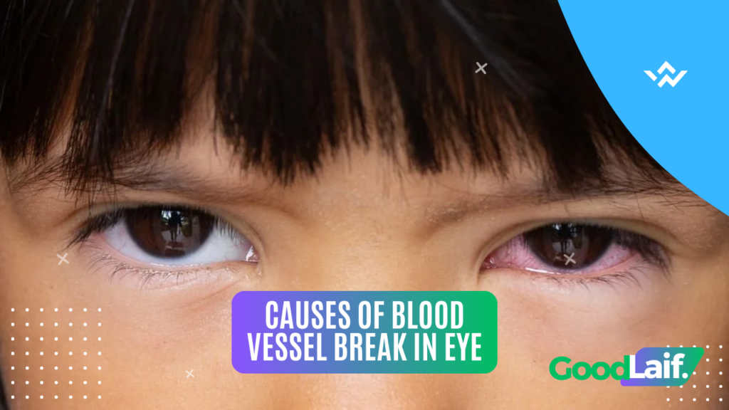 Causes of Blood Vessel Break in Eye