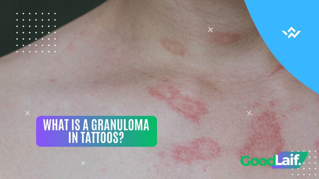 What Is a Granuloma in Tattoos?