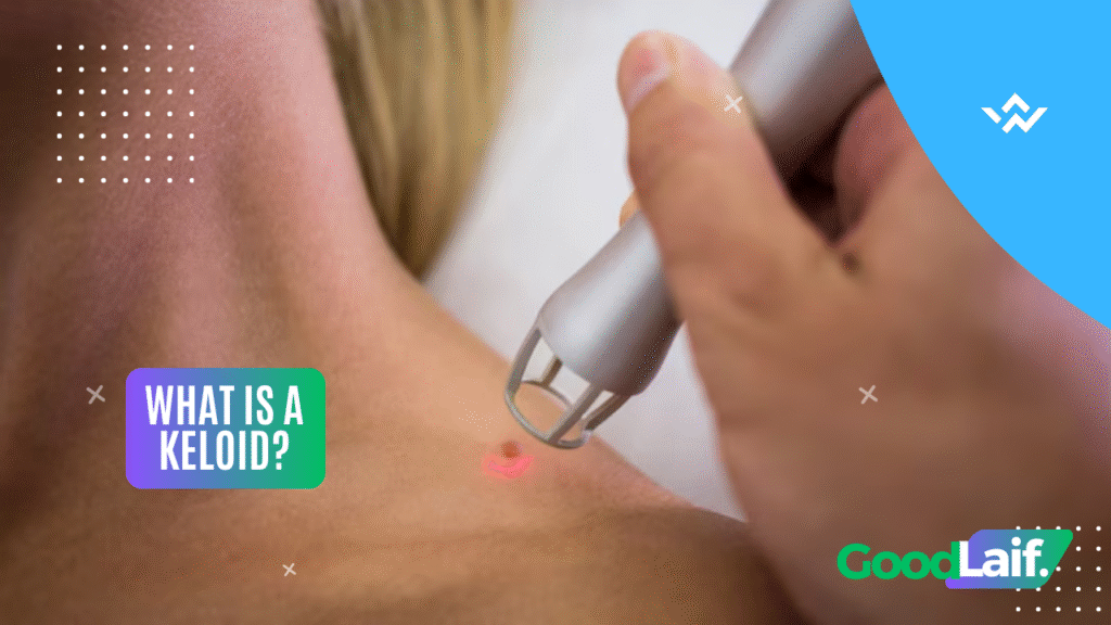 What Is a Keloid?