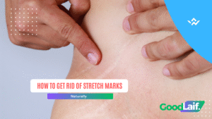 How to Get Rid of Stretch Marks Naturally