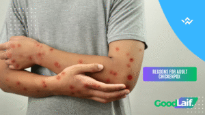 Reasons for Adult Chickenpox