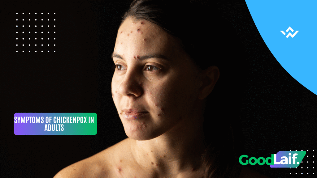 Reasons for Adult Chickenpox