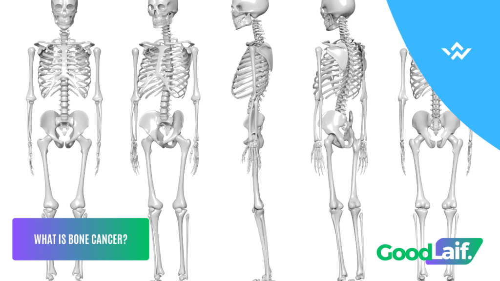 Bone Cancer Can It Be Cured