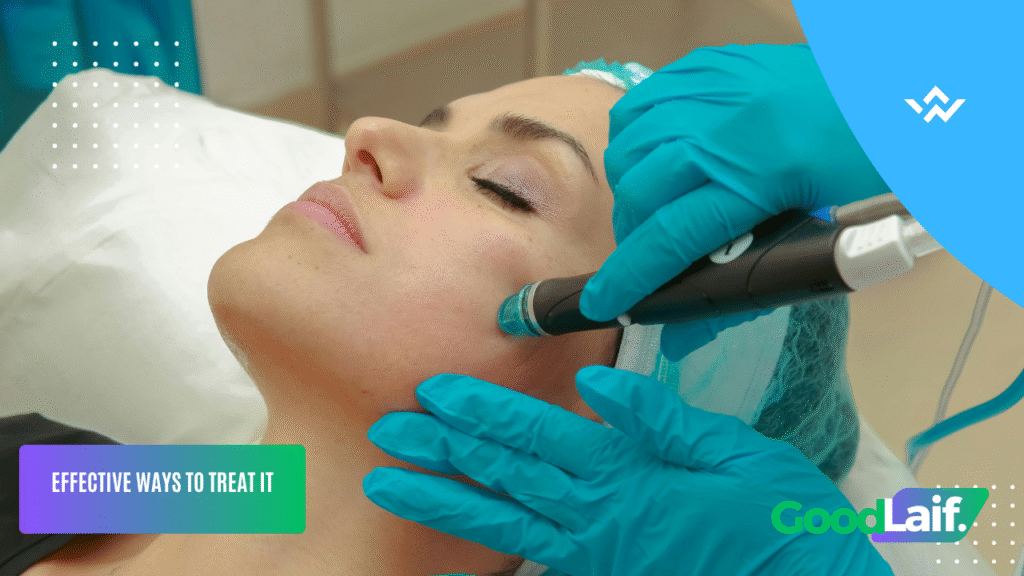 Cystic Acne on the Nose