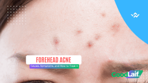 Forehead Acne