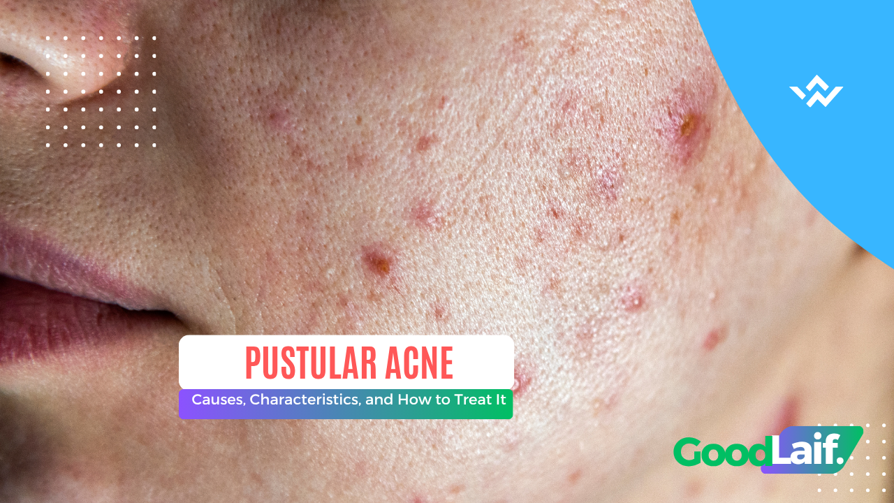 Pustular Acne