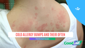 Cold Allergy Bumps