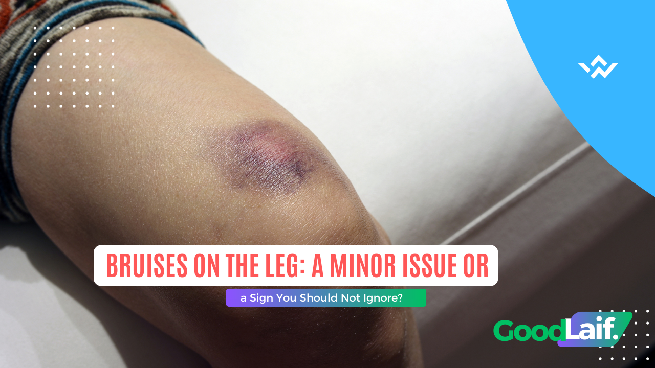 Bruises on the Leg