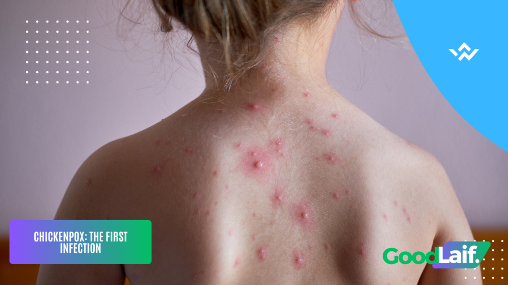 Varicella Zoster Virus