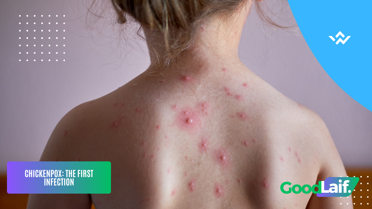 Chickenpox Initial Rash Varicella Zoster Virus: The Cause of Chickenpox and Herpes Zoster ...