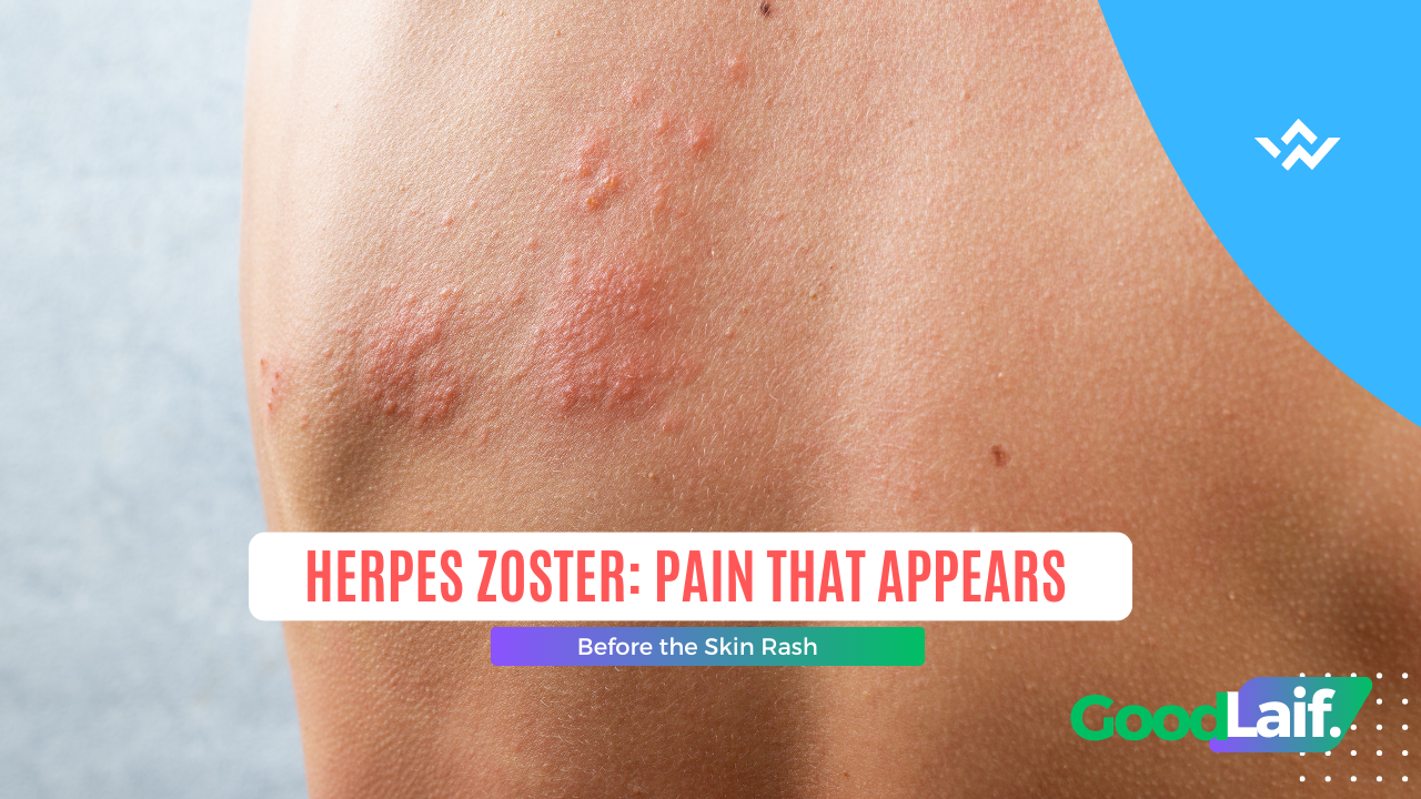 Herpes Zoster