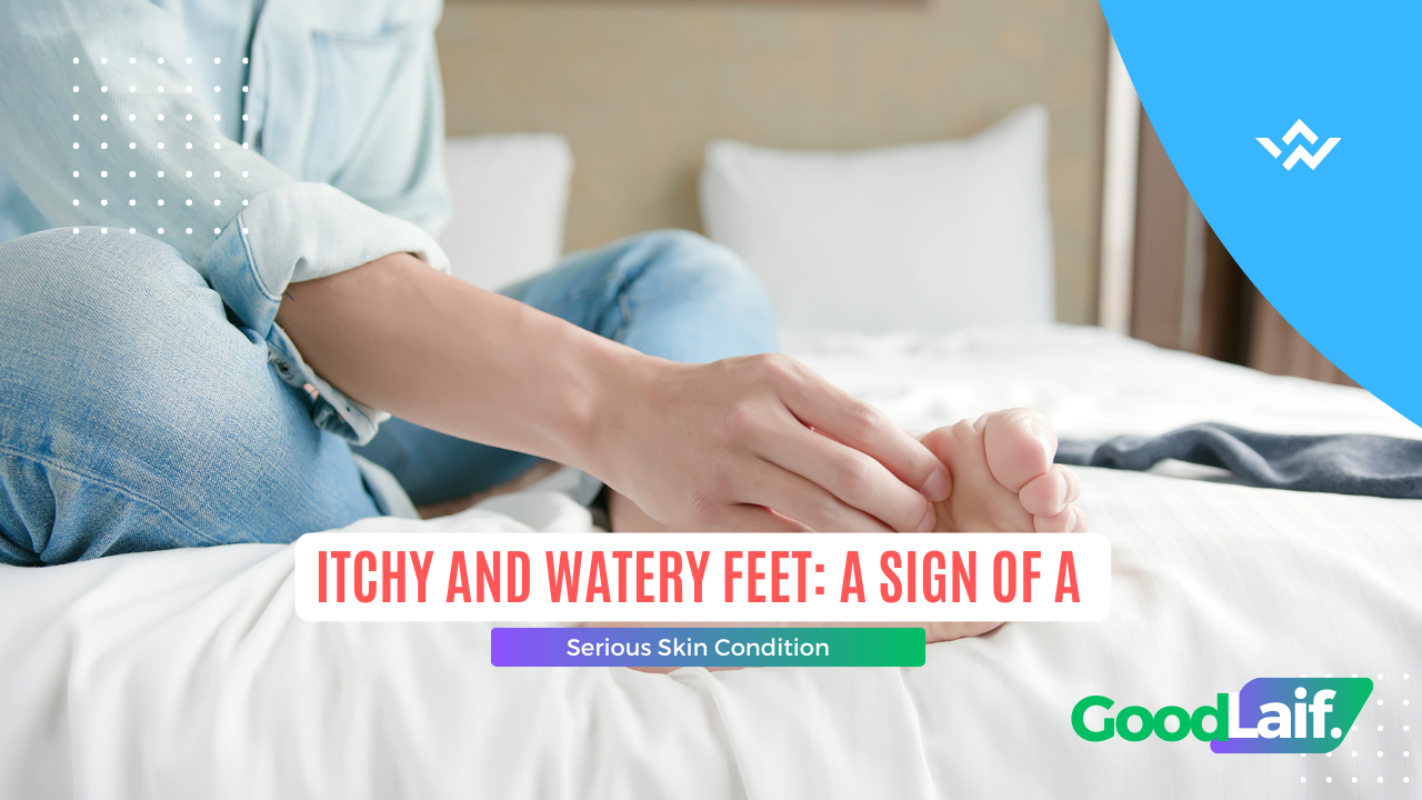 Itchy and Watery Feet