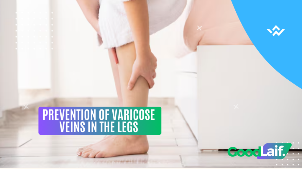 Prevention of Varicose Veins in the Legs