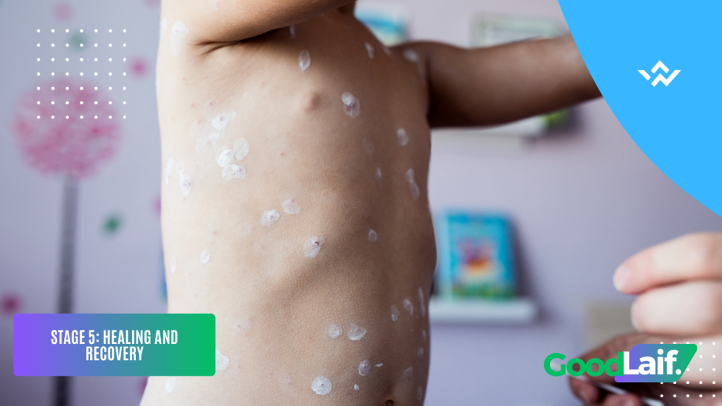 Stages of Chickenpox