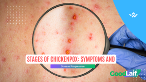 Stages of Chickenpox