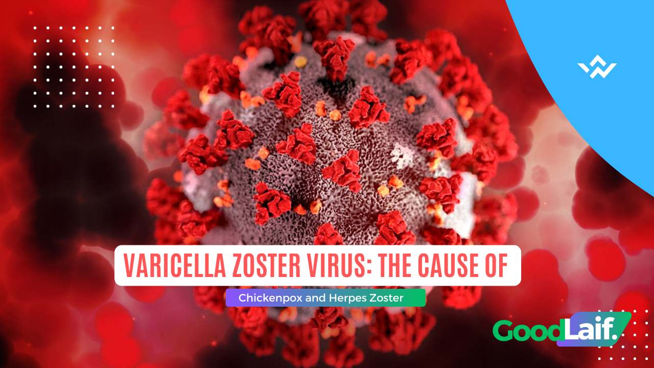 Varicella Zoster Virus