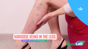 Varicose Veins in the Legs: Protect Your Legs Starting Now