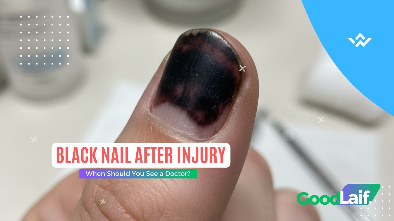 Black Nail After Injury When Should You See a Doctor?