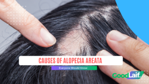 Causes of Alopecia Areata