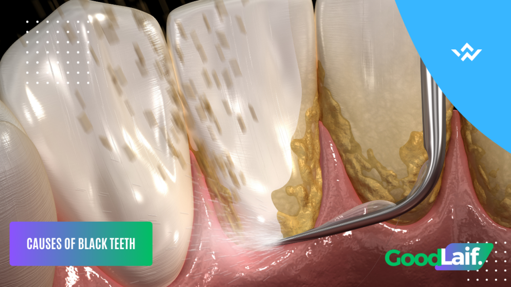 How to Remove Black Teeth