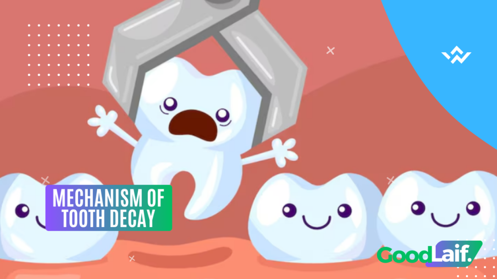 Mechanism of Tooth Decay