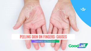 Peeling Skin on Fingers