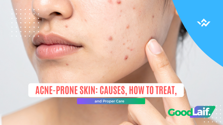 Acne-Prone Skin: Causes, How to Treat, and Proper Care