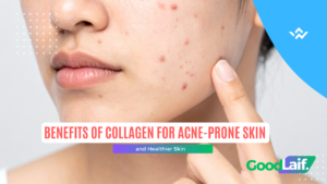 Benefits of Collagen for Acne-Prone Skin