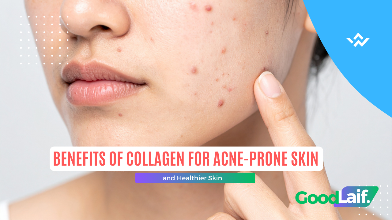Benefits of Collagen for Acne-Prone Skin