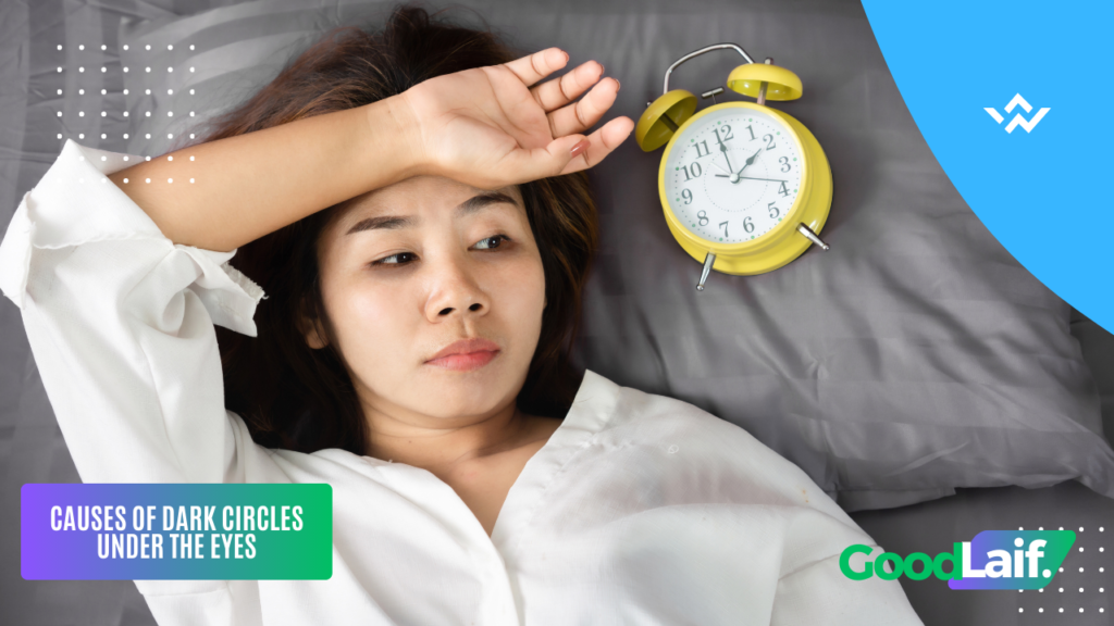 Dark Circles Under the Eyes