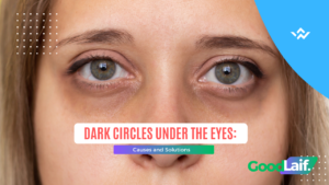 Dark Circles Under the Eyes