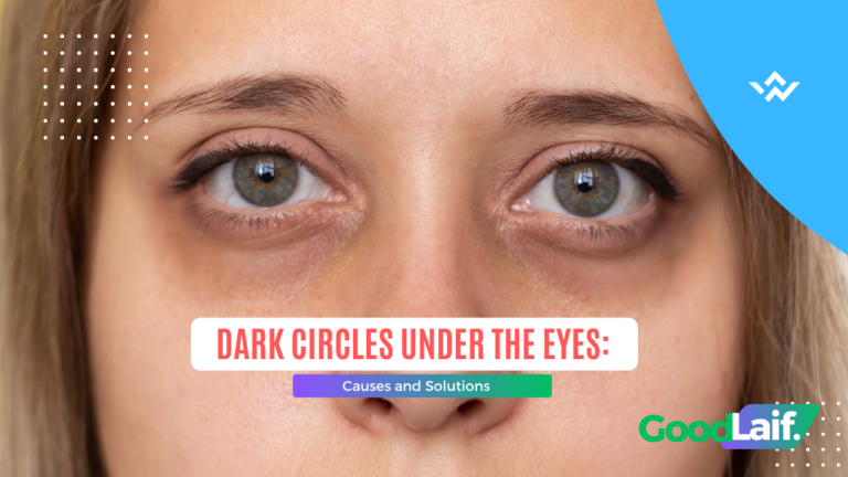 Dark Circles Under the Eyes: Causes and Solutions