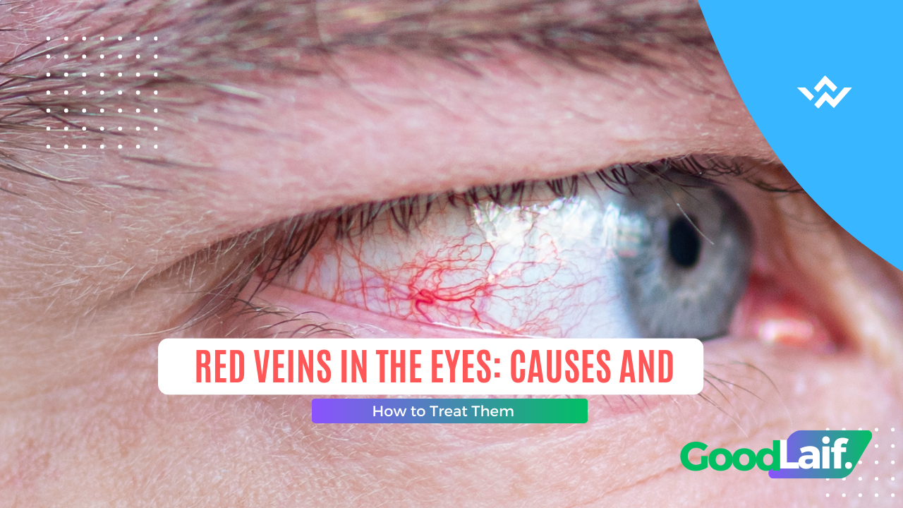 Red Veins in the Eyes