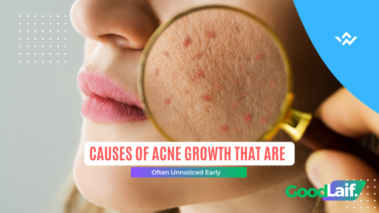 Causes of Acne Growth That Are Often Unnoticed Early