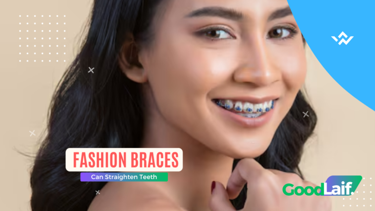 Fashion Braces Can Straighten Teeth