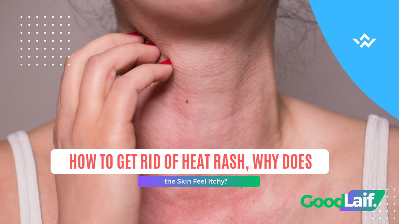 How to Get Rid of Heat Rash