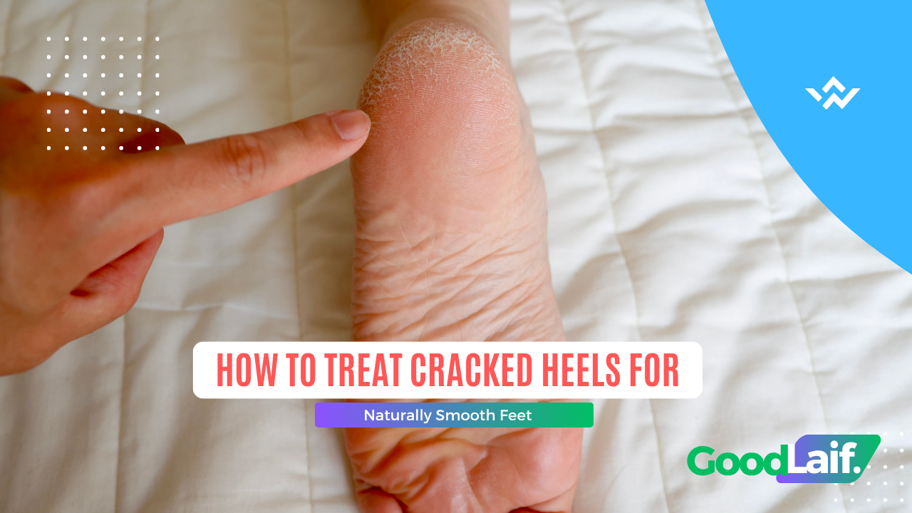 How to Treat Cracked Heels