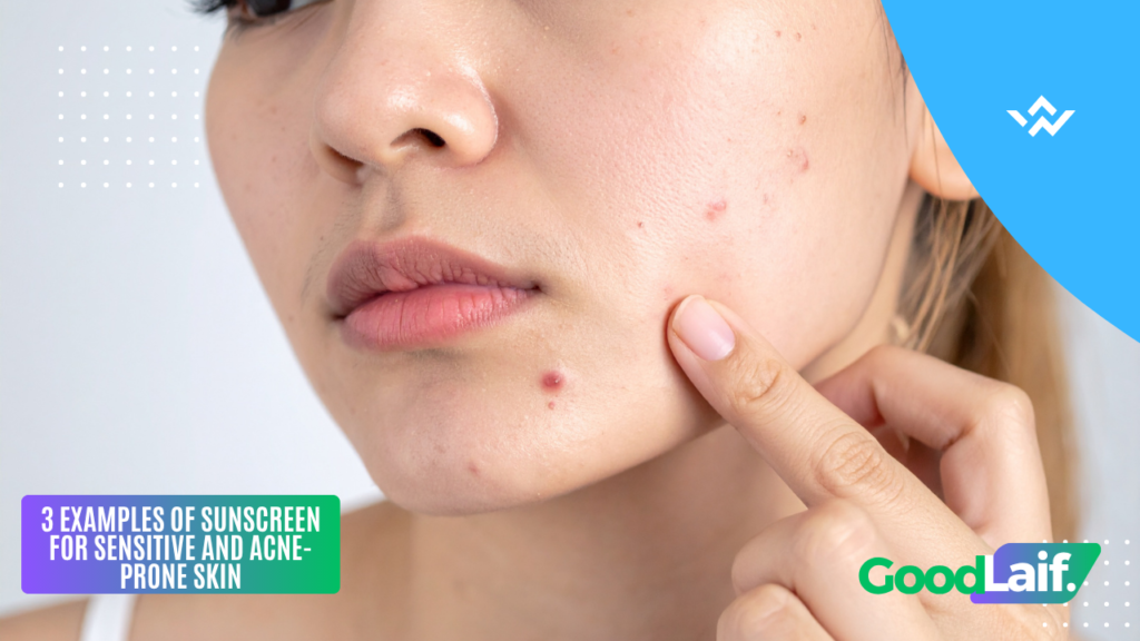 Acne-prone skin experiencing breakouts possibly caused by unsuitable sunscreen for sensitive skin