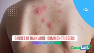 Causes of back acne from clogged pores due to oil and dead skin cells