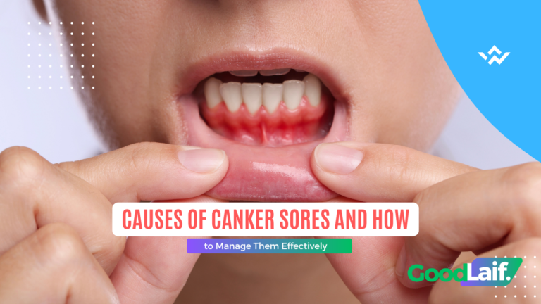 Causes of Canker Sores and How to Manage Them Effectively
