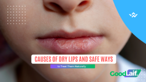 Causes of dry chapped lips and how to treat them safely