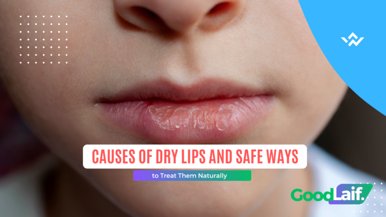 Causes of Dry Lips and Safe Ways to Treat Them Naturally