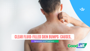 Illustration of clear fluid skin blisters on the back: example of itchy watery skin bumps caused by mild irritation or allergic reaction