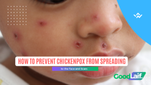 Chickenpox rash on skin, illustration of how to prevent chickenpox from getting worse on the face and minimize scarring