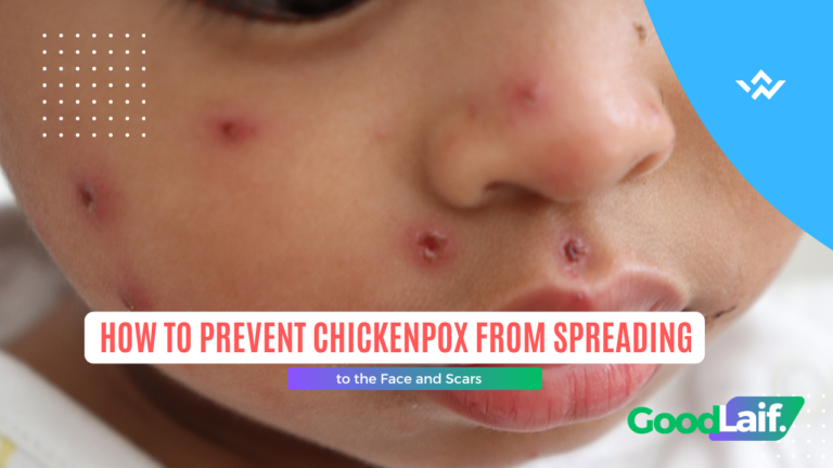 How to Prevent Chickenpox from Spreading to the Face and Scars