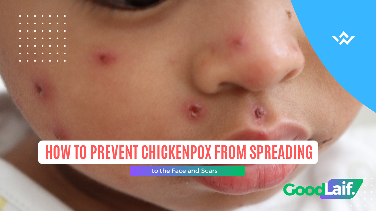 Chickenpox rash on skin, illustration of how to prevent chickenpox from getting worse on the face and minimize scarring