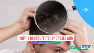 Person scratching itchy scalp due to dandruff, explaining why is dandruff itchy and uncomfortable