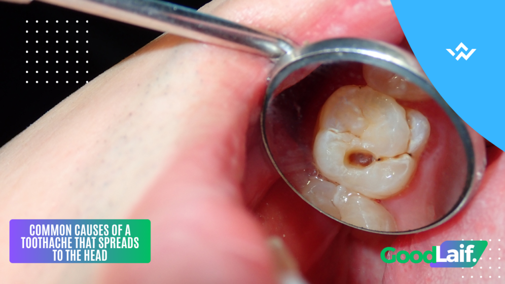 Close-up photo of a cavity inside the mouth that can cause a toothache that spreads to the head