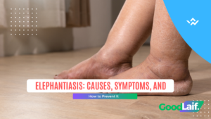 Example of severe leg swelling in a patient with elephantiasis or lymphatic filariasis